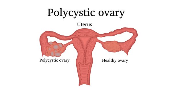 PCOS