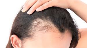 Hair Loss